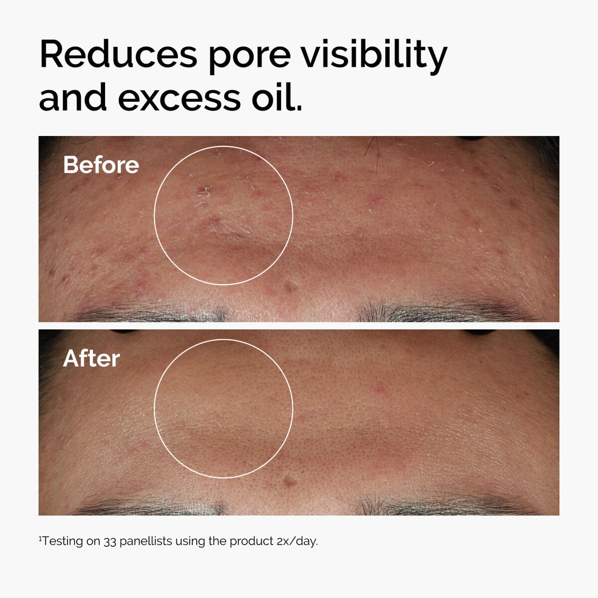 niacinamide-10-zinc-1-l9 ord-niacinamide-zinc-blemish-serum-before-after-pores.jpg