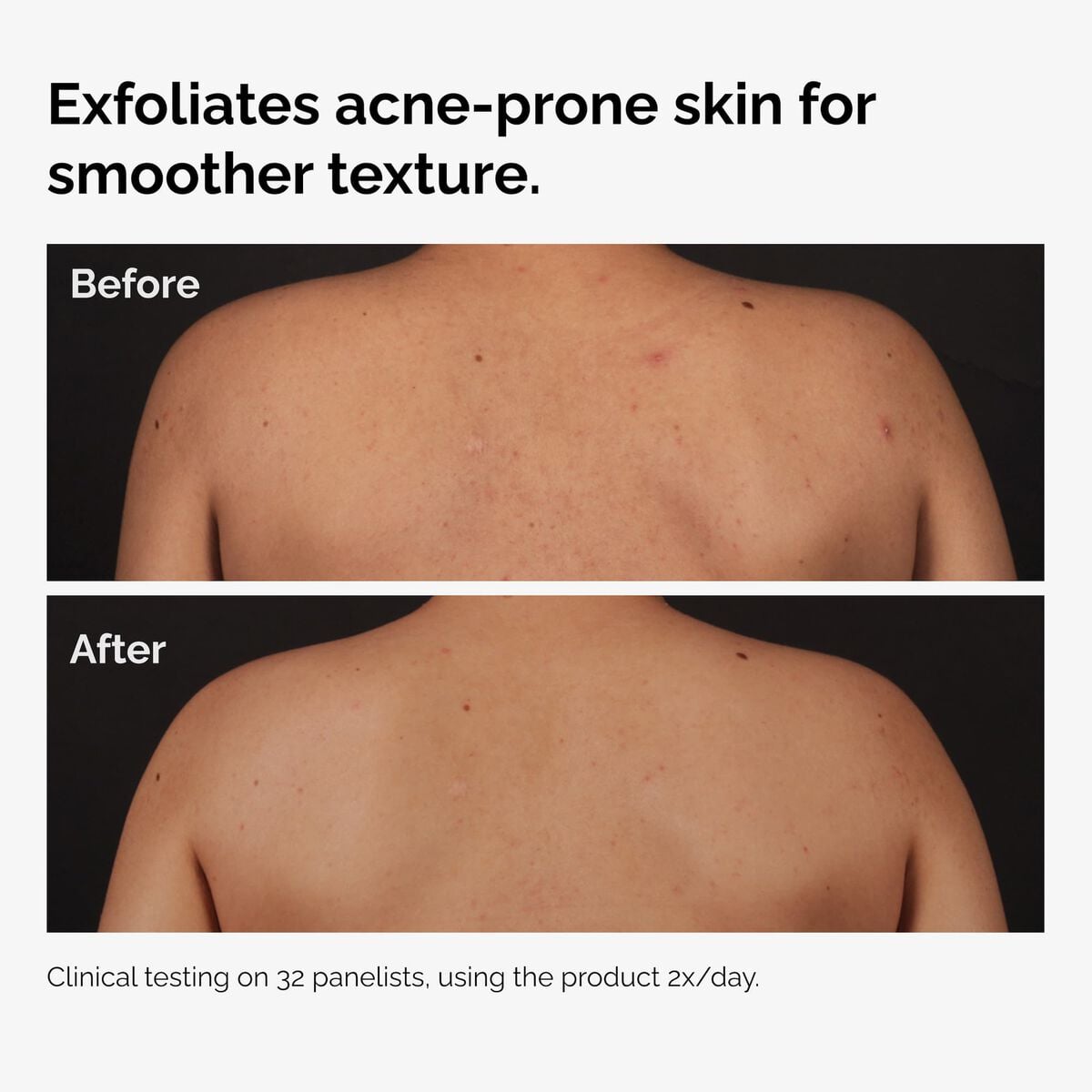 salicylic-acid-0-5-body-serum-y6 ord-salicylic-acid-body-serum-before-after-graphic-NA.jpg